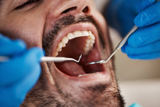 Best Knocked-Out Tooth (Avulsed Tooth) Treatment in Moodys, OK